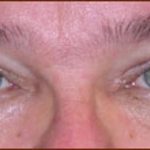 Blepharoplasty Before & After Patient #944