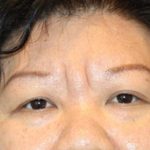 Brow Lift Before & After Patient #945