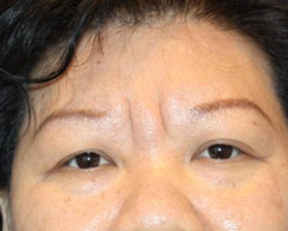 Brow Lift Before & After Patient #945