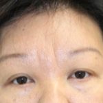 Brow Lift Before & After Patient #945