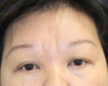 Brow Lift Before & After Patient #945