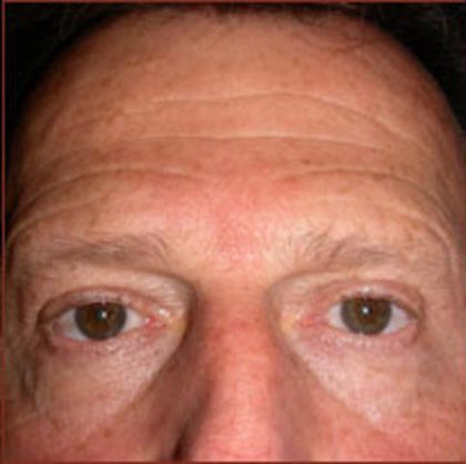 Brow Lift Before & After Patient #946