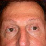 Brow Lift Before & After Patient #946