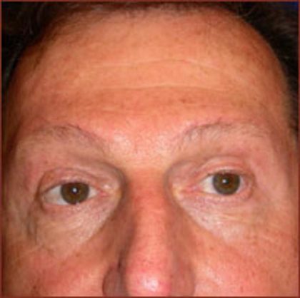 Brow Lift Before & After Patient #946