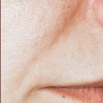 Dermal Fillers Before & After Patient #1178
