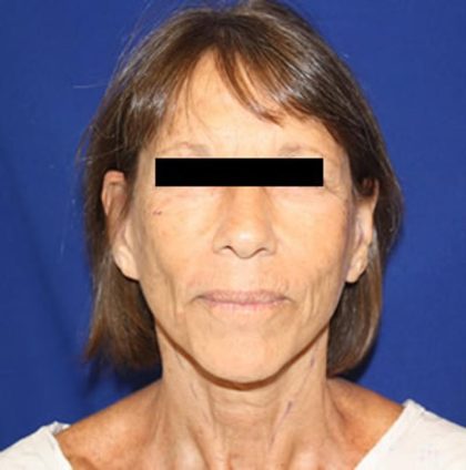 Facelift Before & After Patient #948
