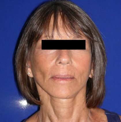 Facelift Before & After Patient #948