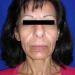 Facelift Before & After Patient #949