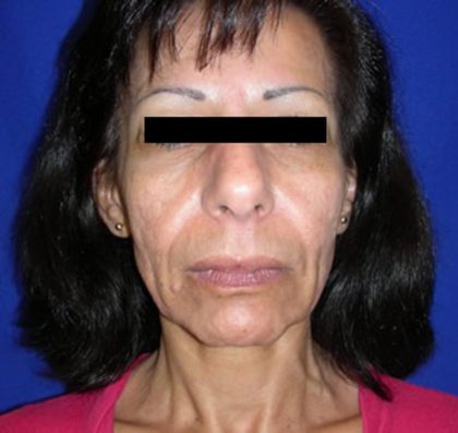 Facelift Before & After Patient #949