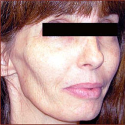 Facelift Before & After Patient #950