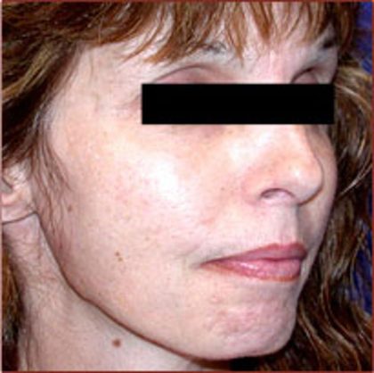 Facelift Before & After Patient #950