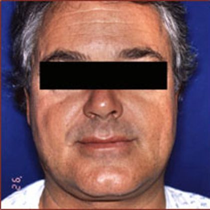 Facelift Before & After Patient #951