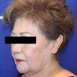 Facelift Before & After Patient #952