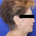 Facelift Before & After Patient #952