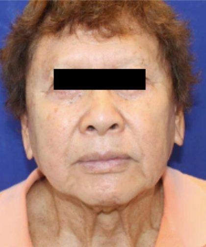 Facelift Before & After Patient #954