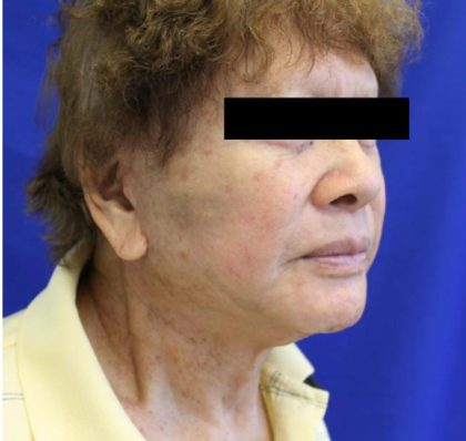 Facelift Before & After Patient #954