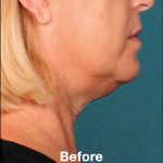 Kybella Before & After Patient #1212