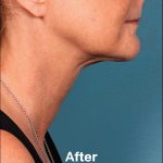 Kybella Before & After Patient #1213