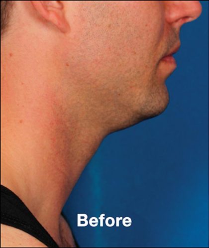 Kybella Before & After Patient #1214