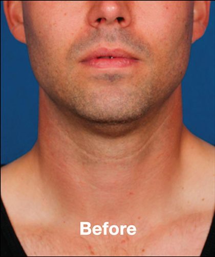 Kybella Before & After Patient #1218
