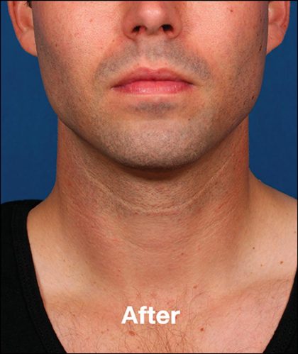 Kybella Before & After Patient #1218