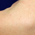 Laser Skin Resurfacing Before & After Patient #1219