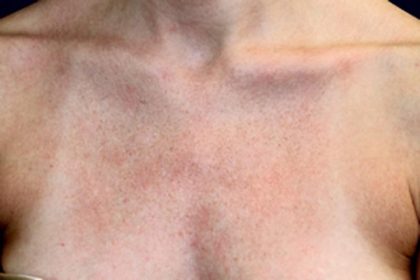 Laser Skin Resurfacing Before & After Patient #1220