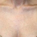 Laser Skin Resurfacing Before & After Patient #1220