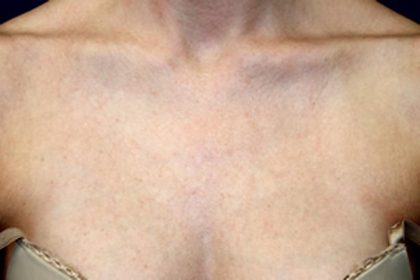 Laser Skin Resurfacing Before & After Patient #1220