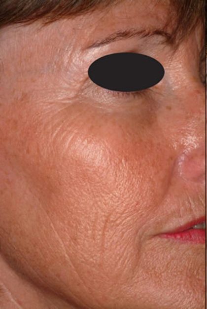 Laser Skin Resurfacing Before & After Patient #1221
