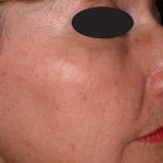 Laser Skin Resurfacing Before & After Patient #1221