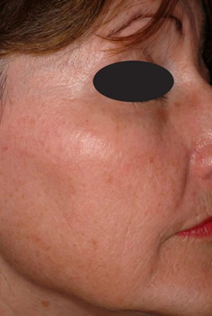 Laser Skin Resurfacing Before & After Patient #1221