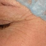 Laser Skin Resurfacing Before & After Patient #1222
