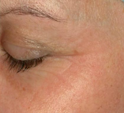Laser Skin Resurfacing Before & After Patient #1222