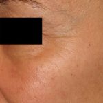 Laser Skin Resurfacing Before & After Patient #1223