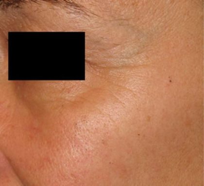 Laser Skin Resurfacing Before & After Patient #1223