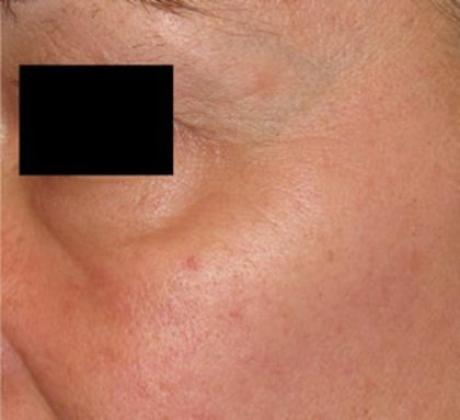 Laser Skin Resurfacing Before & After Patient #1223