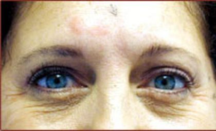 Laser Skin Resurfacing Before & After Patient #1226