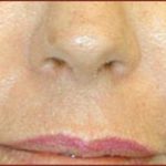 Laser Skin Resurfacing Before & After Patient #1227