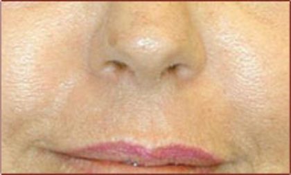 Laser Skin Resurfacing Before & After Patient #1227