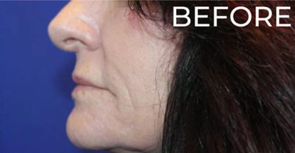 Lip Lift Before & After Patient #956