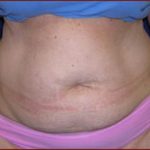 Liposuction Before & After Patient #862