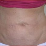 Liposuction Before & After Patient #862