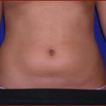 Liposuction Before & After Patient #863