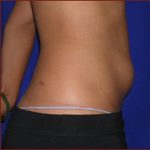 Liposuction Before & After Patient #863