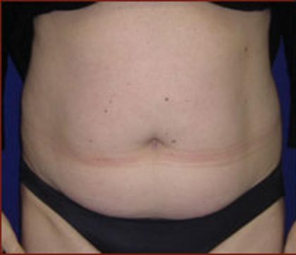 Liposuction Before & After Patient #865