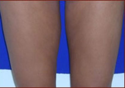 Liposuction Before & After Patient #866