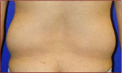 Liposuction Before & After Patient #869