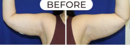 Liposuction Before & After Patient #870