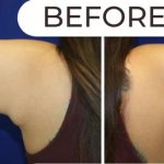 Liposuction Before & After Patient #870